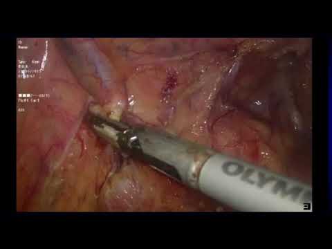 Laparoscopic Restorative Proctocolectomy with Ileal Pouch Anal Anastomosis