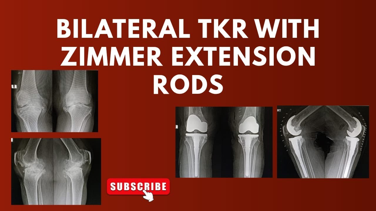 BILATERAL TKR WITH EXTENSION RODS USING ZIMMER LPS IN A MIDDLE AGE ...