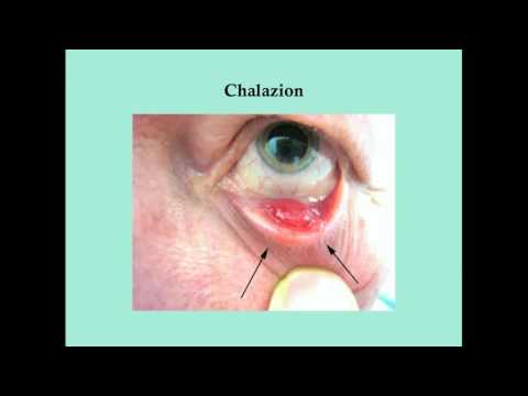 Disorders of the Eye Lid - CRASH! Medical Review Series