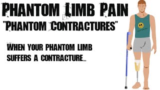 2. Phantom-Kontrakturen – Phantomschmerz und die Spiegeltherapie
