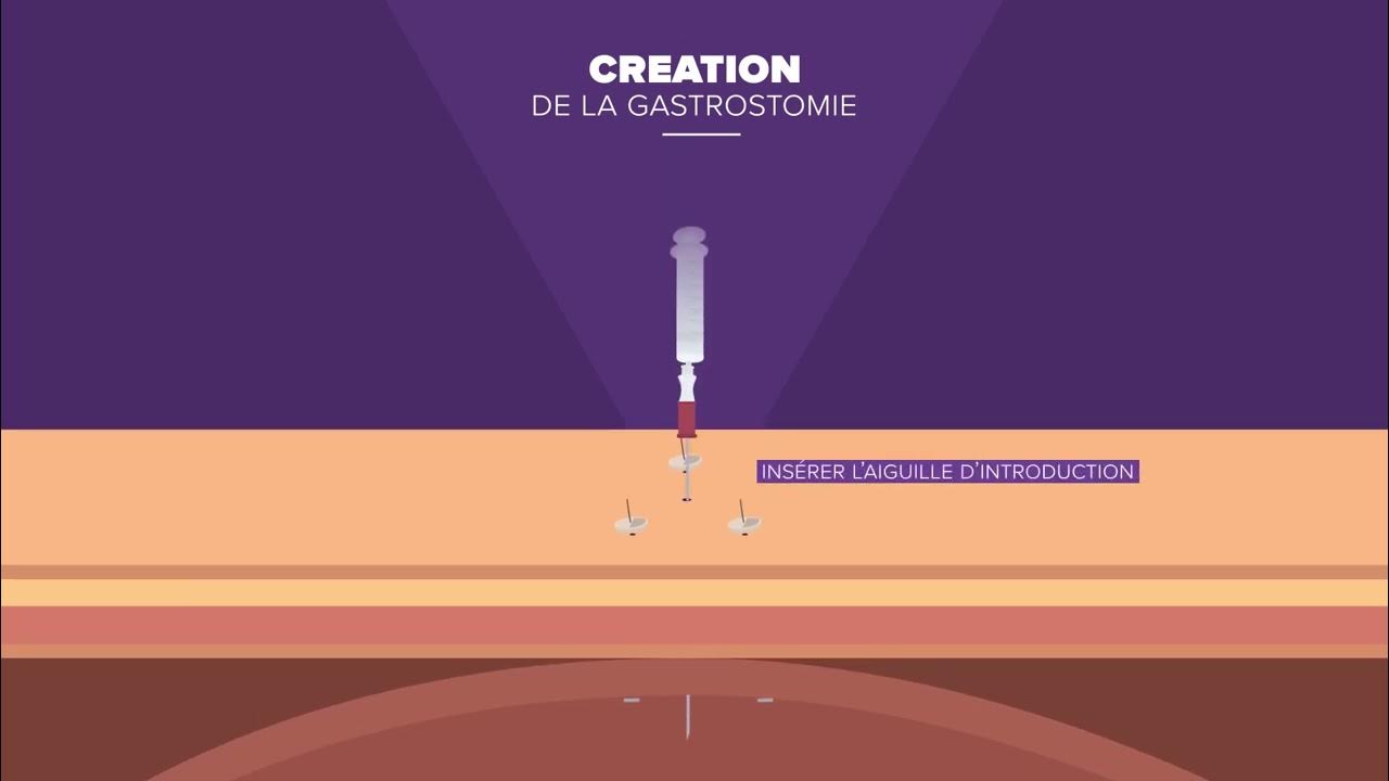 Kit Introducteur MIC®, MICKEY® Guide d'utilisation pour la mise en