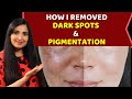 How I ACTUALLY got Rid of Pigmentation & Dark Spots  ||  A Great Drink To Remove  Melasma #Skincare