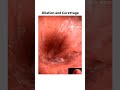 Dilation and curettage #mbbs #neetpg #animation #obgy #aditya gupta #clinical