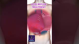 Acid Reflux Laparoscopic Treatment | Minimally Invasive GERD Surgery Explained