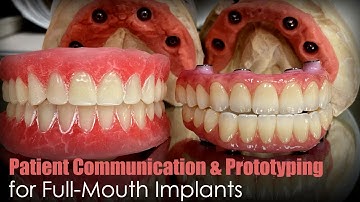 This is the Difference Between Average & Beautiful Full-Mouth Implants