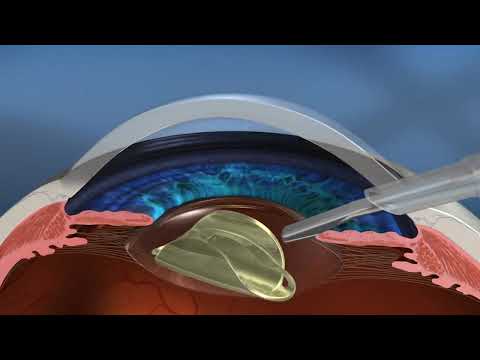 Cirurgia de Catarata a Laser e Convencional