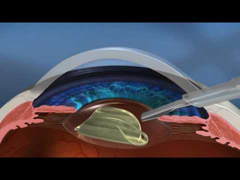 Vídeo: Faça após a cirurgia ocular a laser?