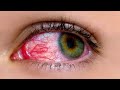 Symptoms and safety of viral pink eye infection by mustasfaa