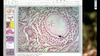 Medical School Pathology 2012 Session 063 Female Genital Tract II.mp4