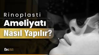 Rinoplasti Ameliyatı Nasıl Yapılır? Adım Adım Burun Estetiği | LIN Europe Klinik