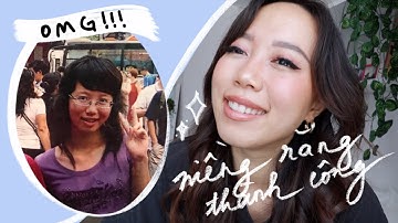 tất tần tật kinh nghiệm niềng răng hô của mình (giá 💲 cụ thể + tip vệ sinh răng trắng tại gia ✨)