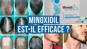 Quand se laver les cheveux après minoxidil