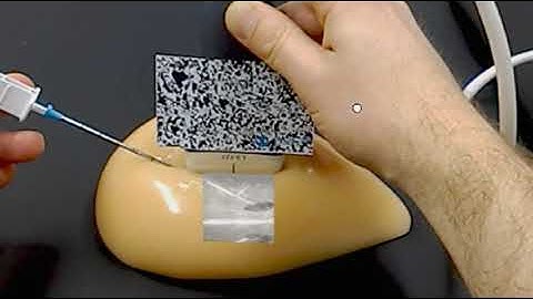 Augmented Reality Ultrasound on Hololens