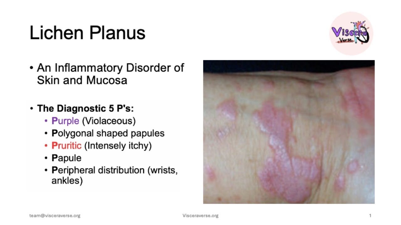 Lichen Planus Made Super Simple!
