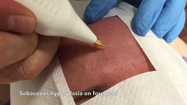 Sebaceous hyperplasia removal