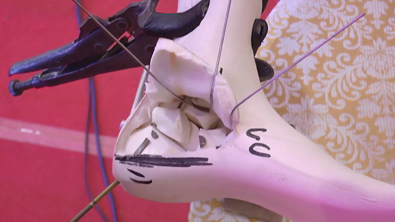 Bone Model Calcaneum fracture fixation, Dr Balvinder Rana, Olwa Foot ...