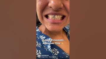 Before & After Hard Stains Removal !! 😃⭐️ #iteethdental  #beforeandafter #shorts