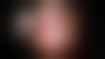 scleral fixation of subluxed IOL/capsular tension ring