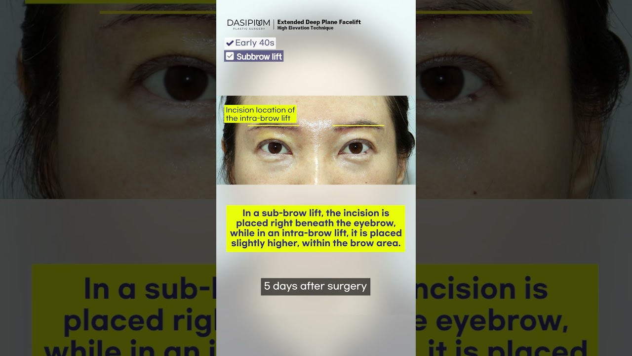 Subbrow vs Intrabrow Lift: The Key Difference 