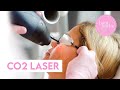 Hautverjüngung mit dem CO2-Laser | Dr. Barbara Franz