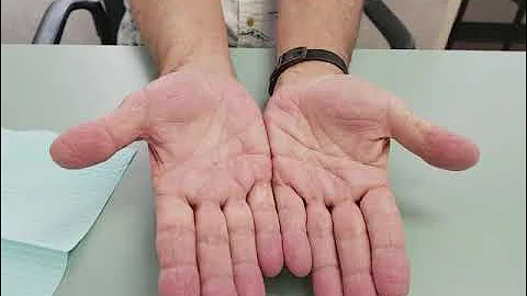 3 months after Coleman basal joint arthroplasty