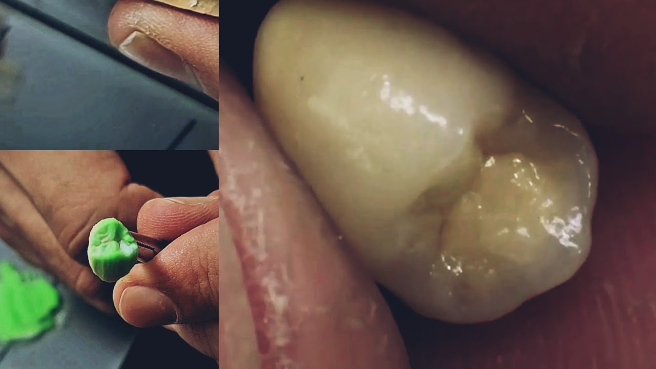 upper Premolar build up ...تخزيف الضاحك العلوي