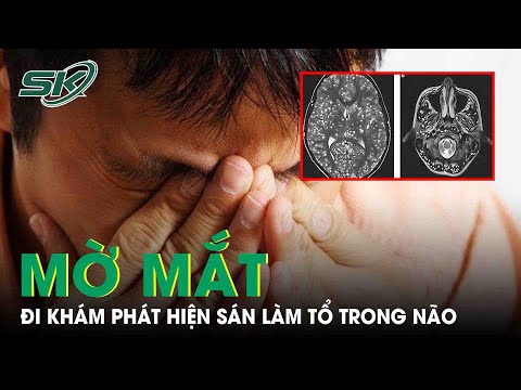 Suy Giảm Thị