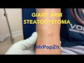 Large Steatocystoma on forearm popped, sac removal and closure with follow up. Many more coming soon