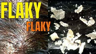 BIG FLAKES - Scalp Psoriasis Removal