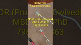 Dr.Dwivedi Acupuncture Clinic#bodyache #cerebralpalsykids #paralysis #insomnia #gastro #narcolepsy