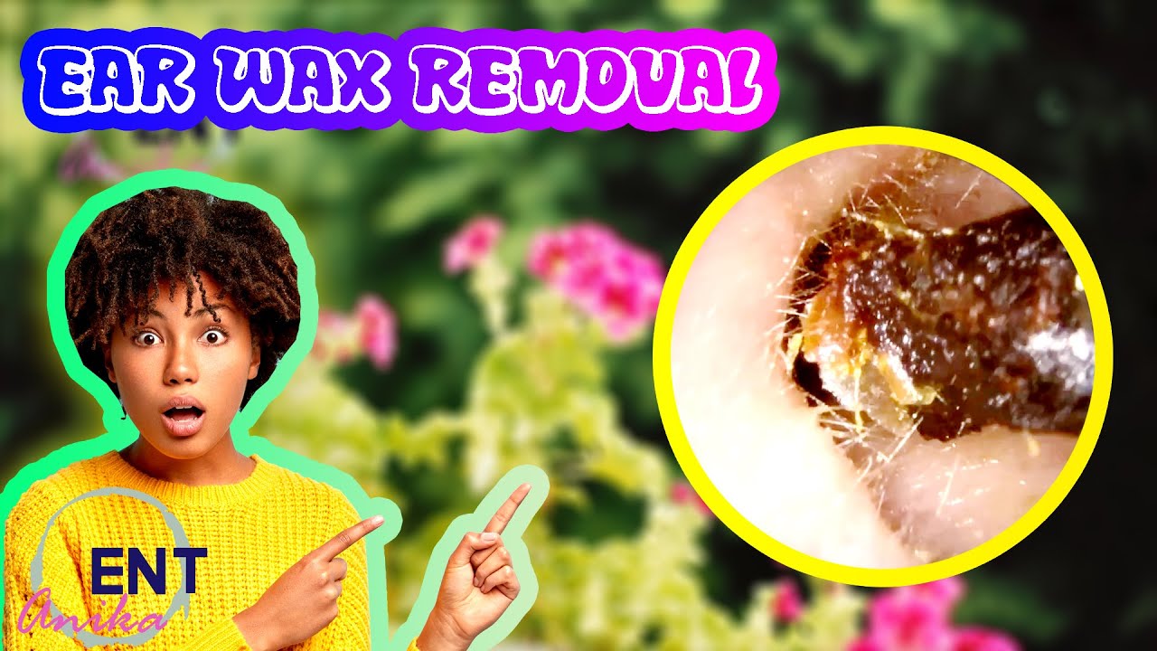 HUGE EAR WAX REMOVAL Very Sticky And Huge Amounts [Ep27] YouTube