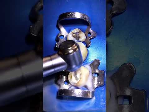 ازالة الحشوة المؤقتة       ترند   اكسبلور