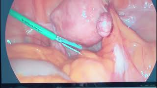 Rahim Kanseri Ameliyatı