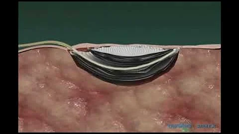 Como é o curativo a vácuo?