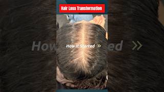 Female hair loss transformation without oral meds #DrHopkirk #HRP™️ #hairlosstreatment #hair #health