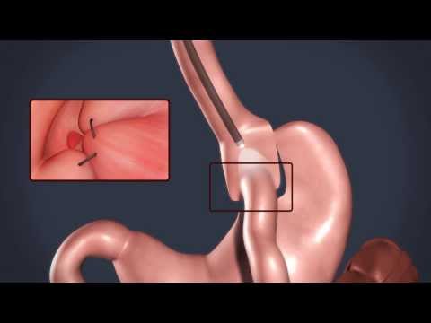 הצרת השקת והקטנת קיבה  לאחר מעקף קיבה - Endoscopic Bypass Revision