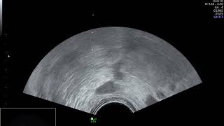 Trus In Ejaculatory Duct Obstruction