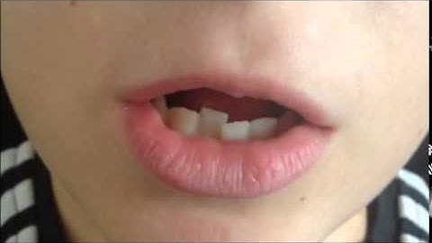 Speech development s sound lisp