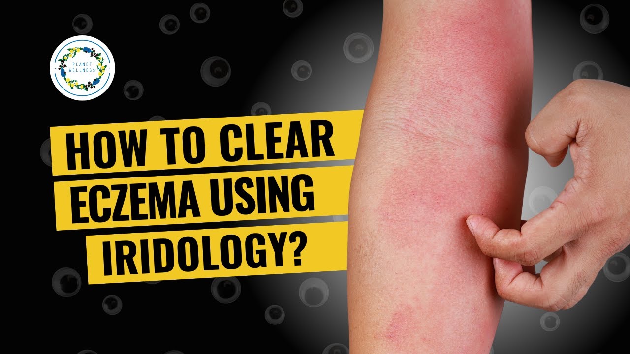 How To Clear Eczema Using Iridology? YouTube