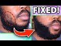 FUE Beard Hair Transplant (900 Grafts; African American Man)