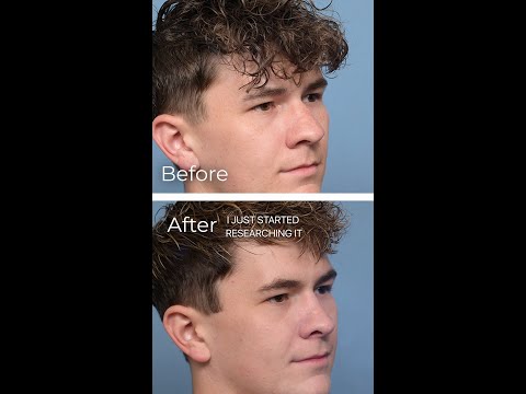Video thumbnail: Logan's Testimonial | Rhinoplasty Results · Mark Hamilton MD
