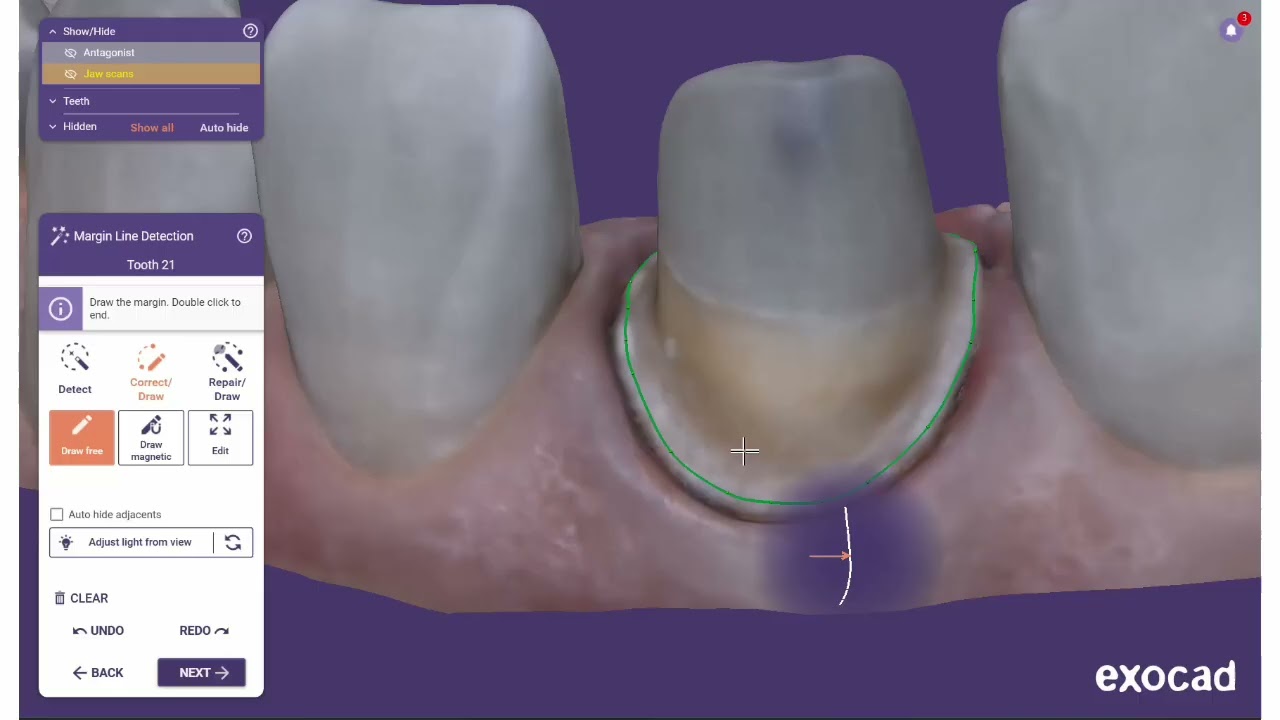 Detect /edit margins Exocad
