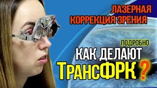 🔴 Как делают ТрансФРК  лазерную коррекцию зрения в Москве? Как проходит операция? Подробно!