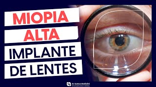 Correção de alta miopia e alto astigmatismo: Implante de Lente Intraocular Fácica - Dr. Gustavo