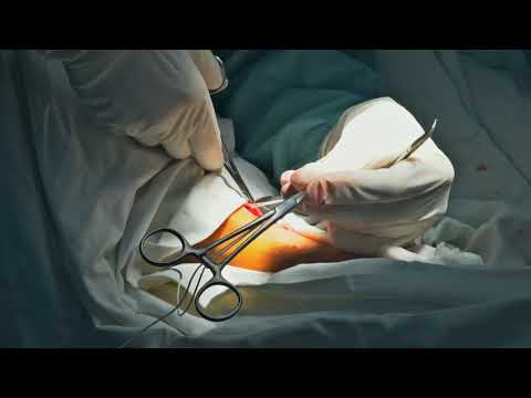 Video: Varicose Vein Stripping: Tujuan, Prosedur, Dan Risiko