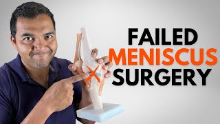 Top 5 Signs Of A Failed Meniscus Surgery