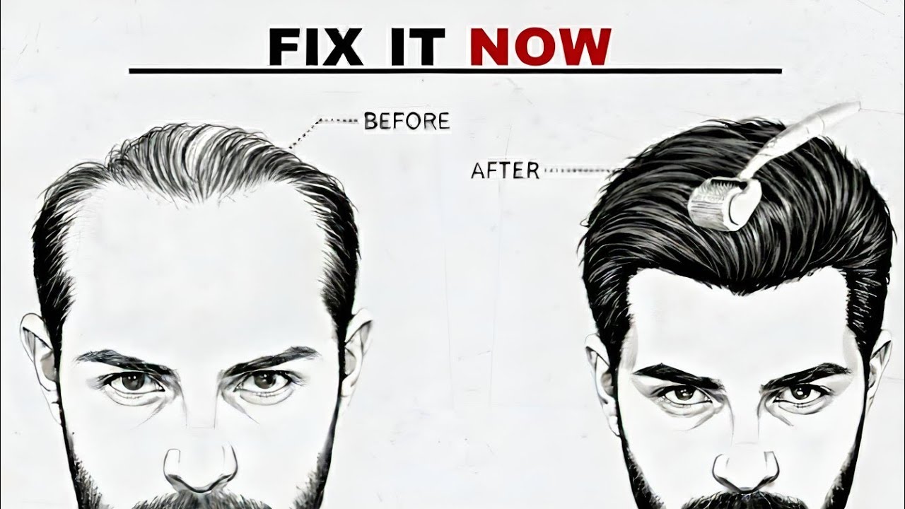 Derma Rolling Secrets for Rapid Hair Growth | Complete Guide to Hair Restoration
