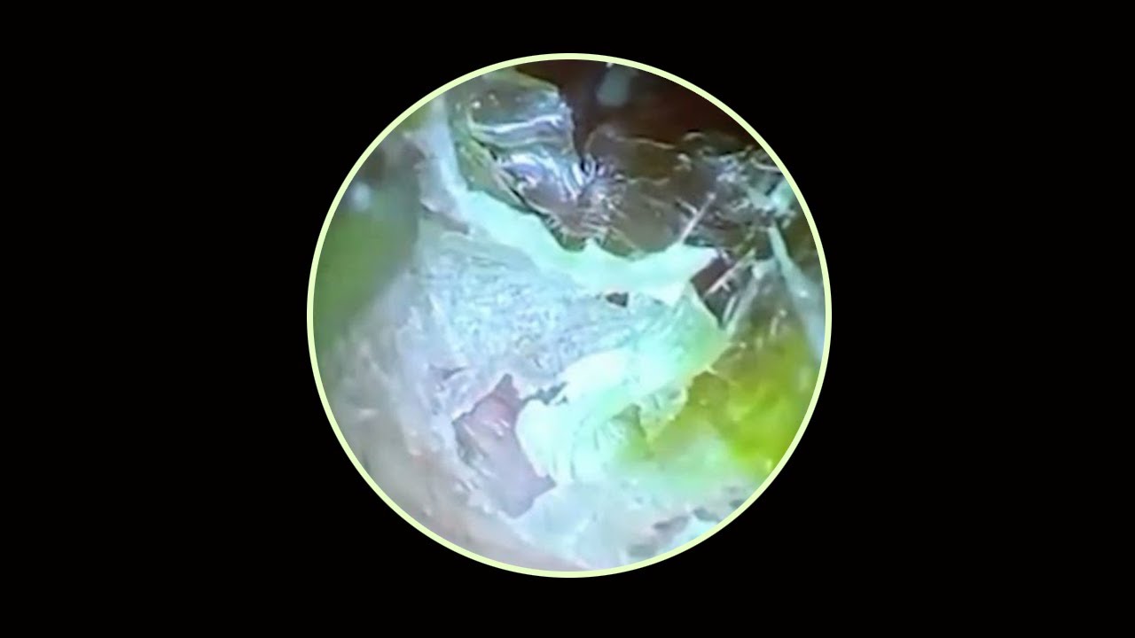 Satisfying Ear Wax Removal With Dr Zhao Video P22 YouTube