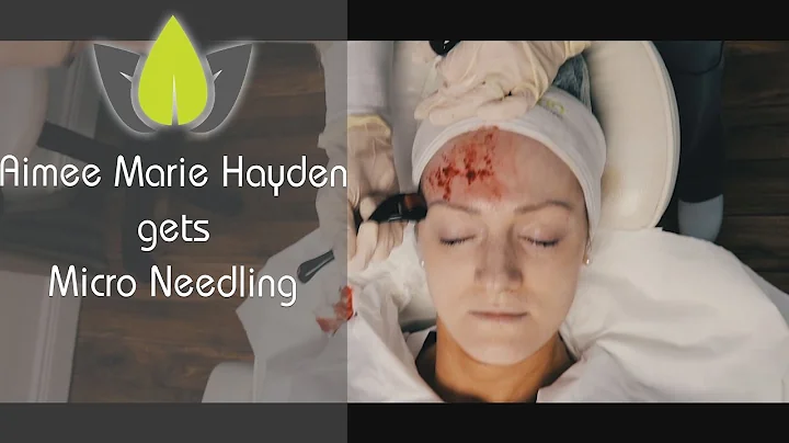 Aimee gets a NEW FACE, MicroNeedling treatment
