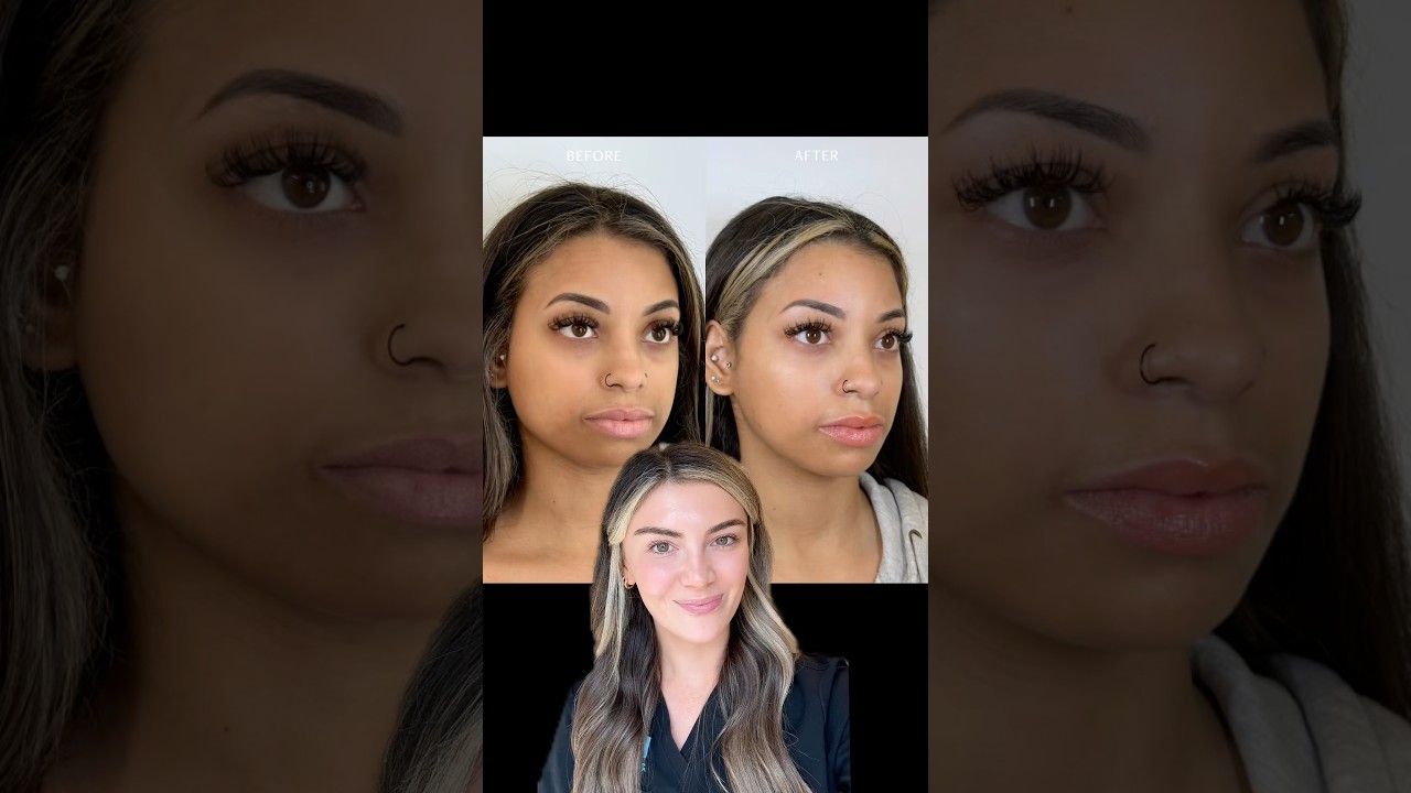 Full Facial Balancing by Rachel 💉